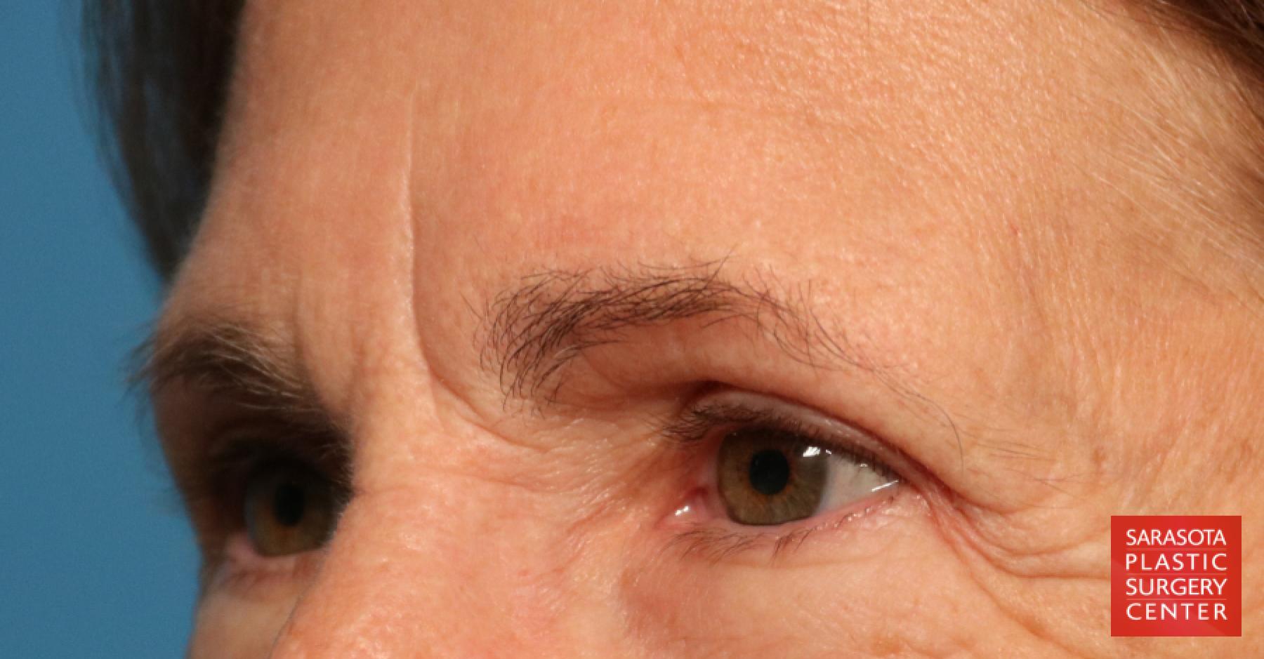 Brow Lift: Patient 1 - Before 2