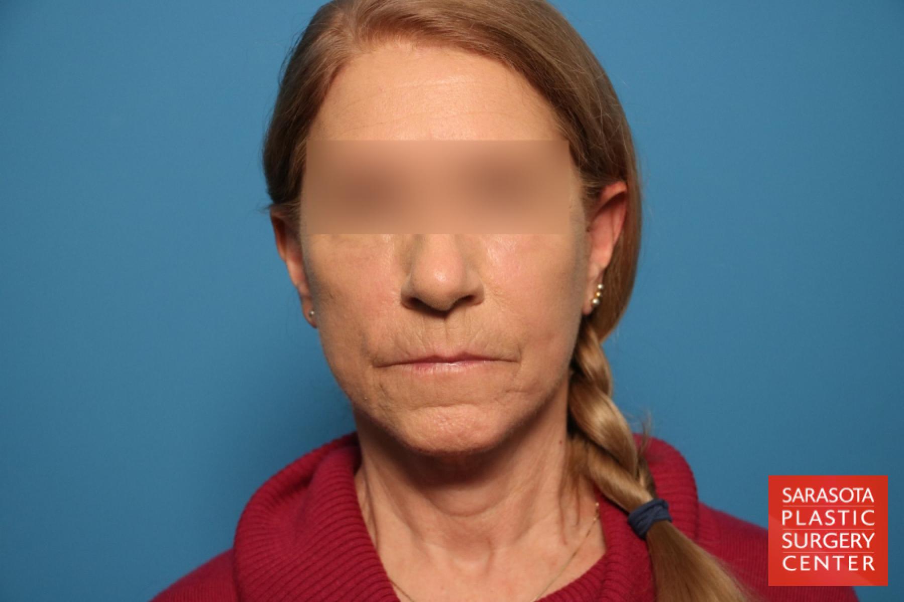 Laser Skin Resurfacing - Face: Patient 13 - After 1