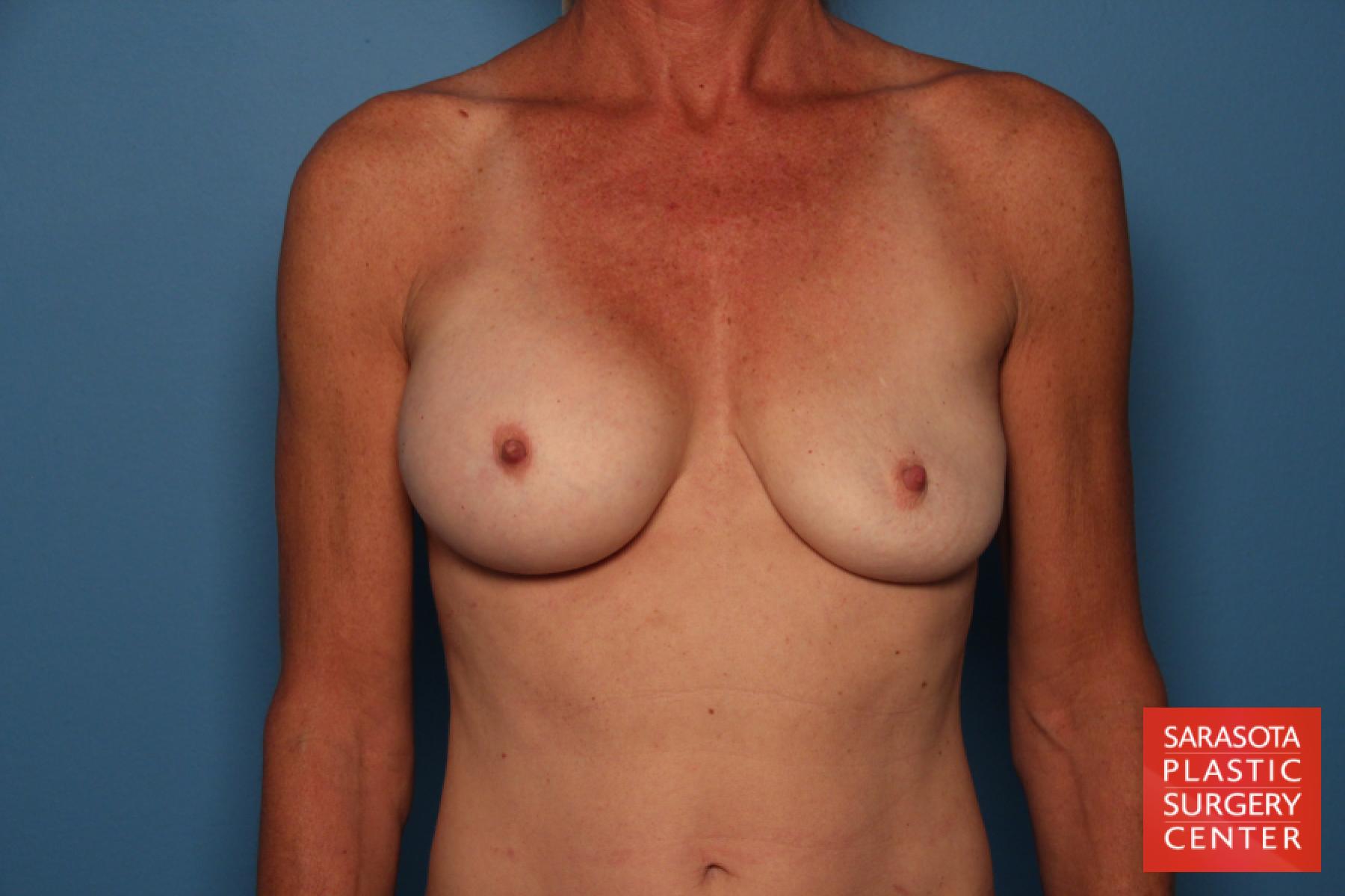 Breast Implant Exchange: Patient 6 - Before 