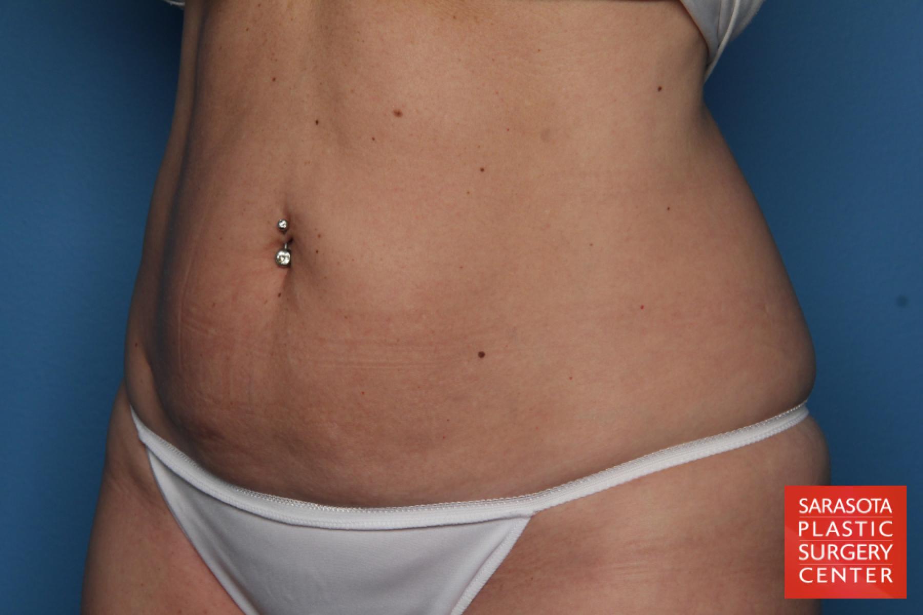 Liposuction: Patient 8 - Before 2
