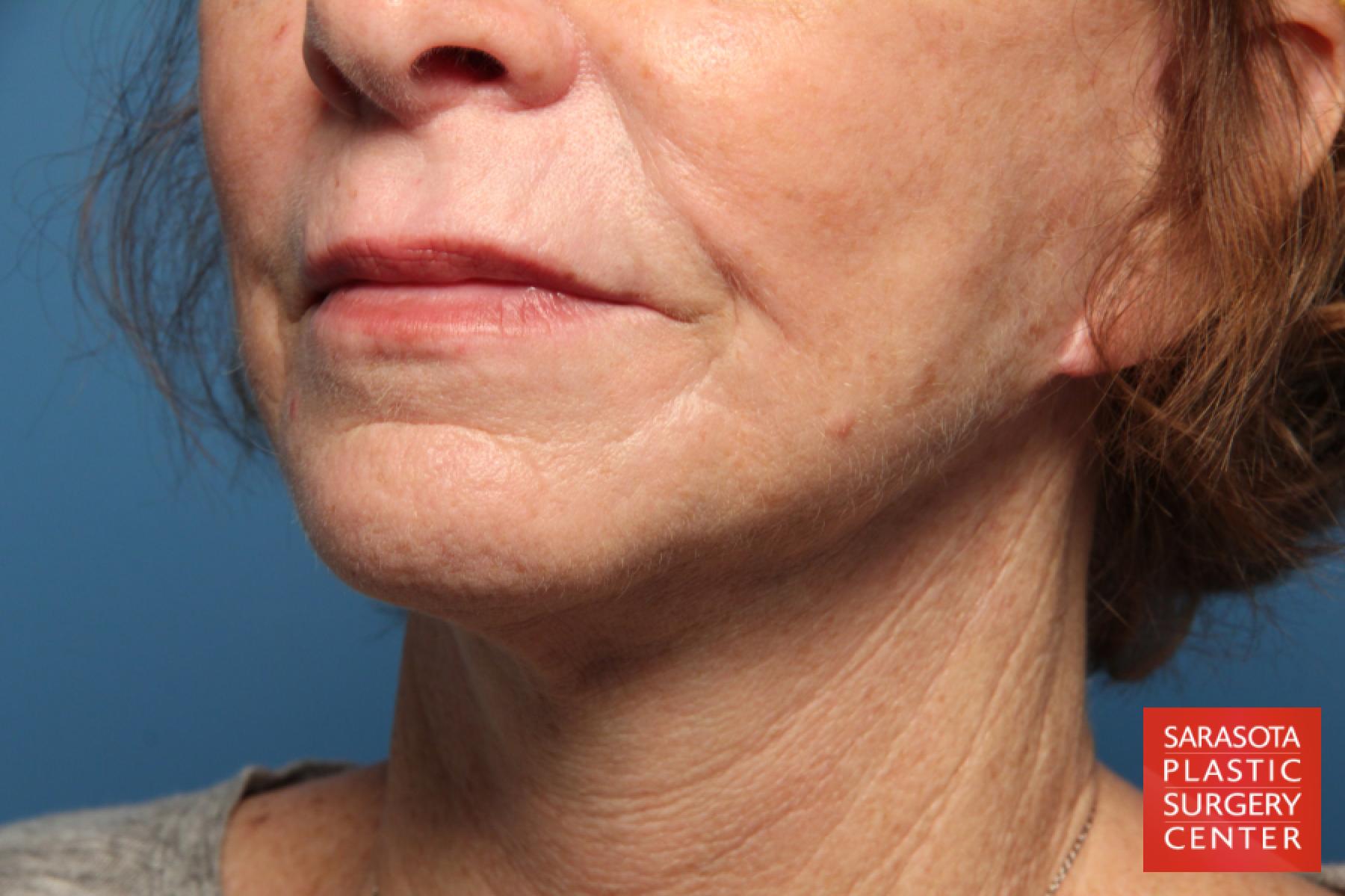 Laser Skin Resurfacing - Face: Patient 12 - After 2