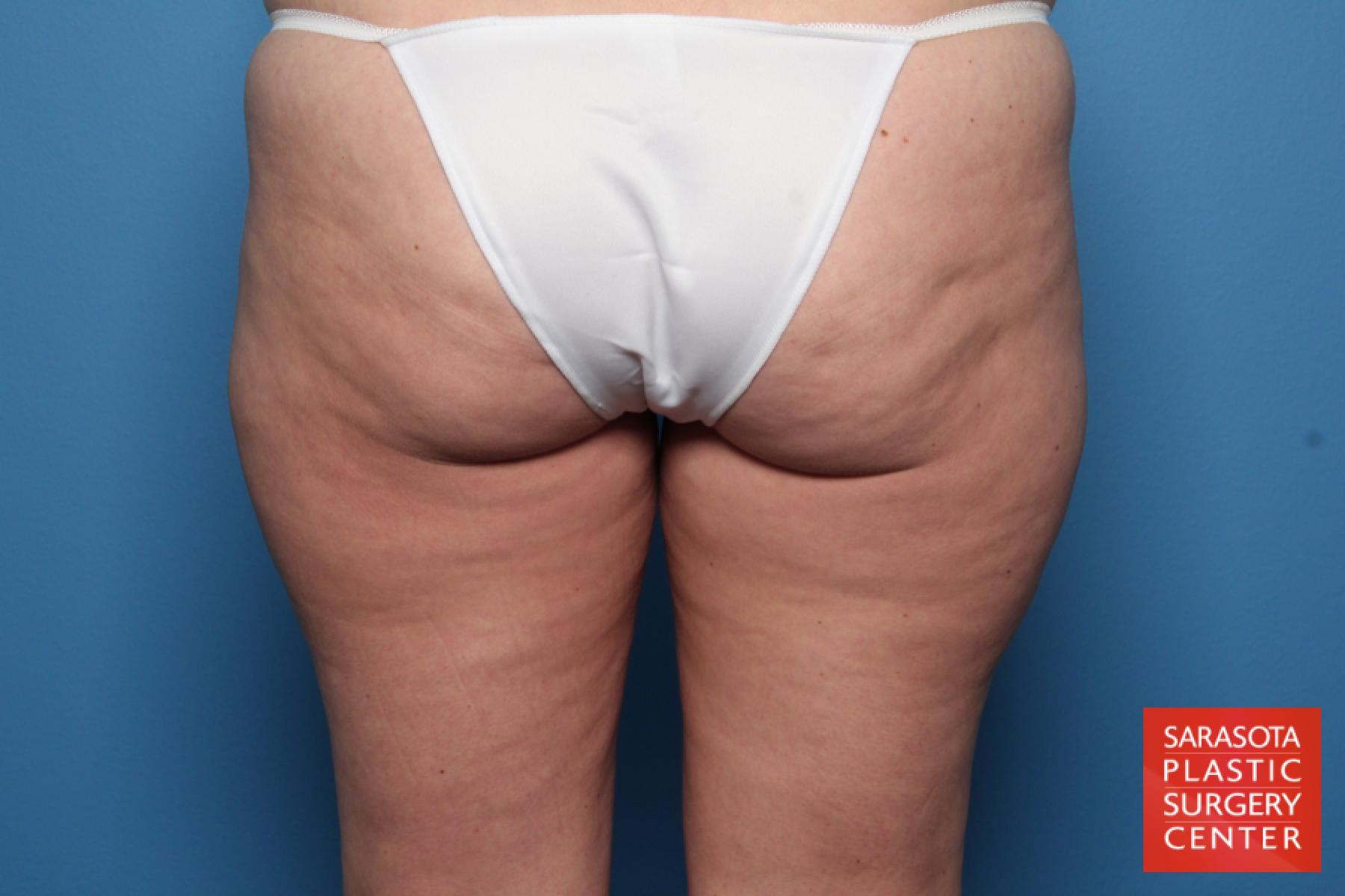 Liposuction: Patient 11 - Before and After 3