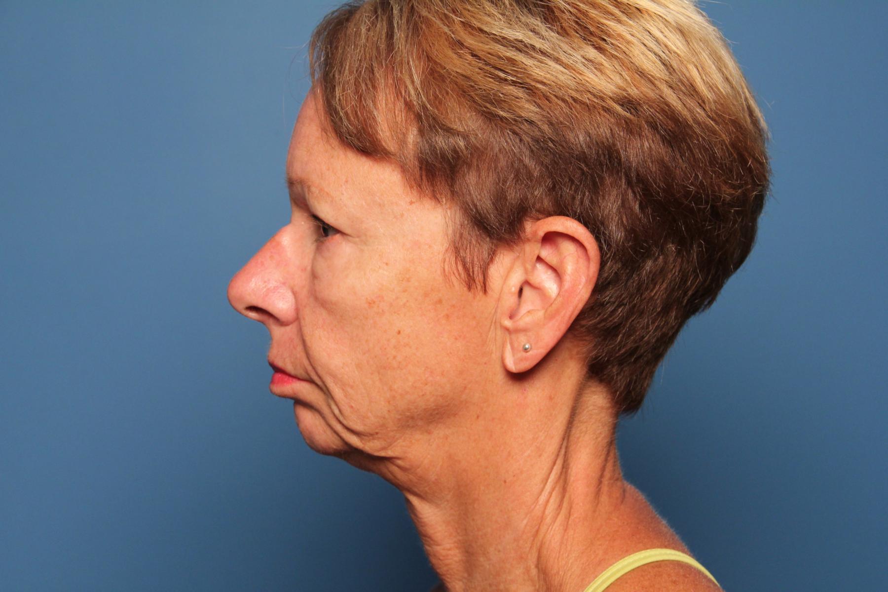 Facelift/Mini Facelift: Patient 4 - Before and After 3