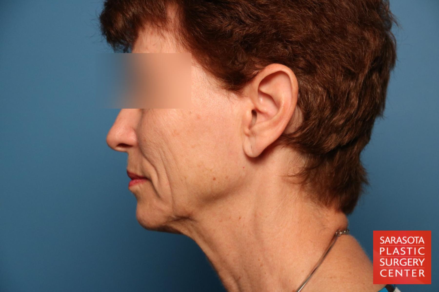 Facelift: Patient 24 - Before and After 3