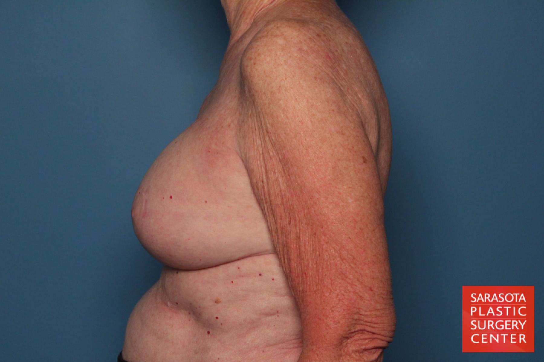 Breast Implant Exchange: Patient 7 - After 3
