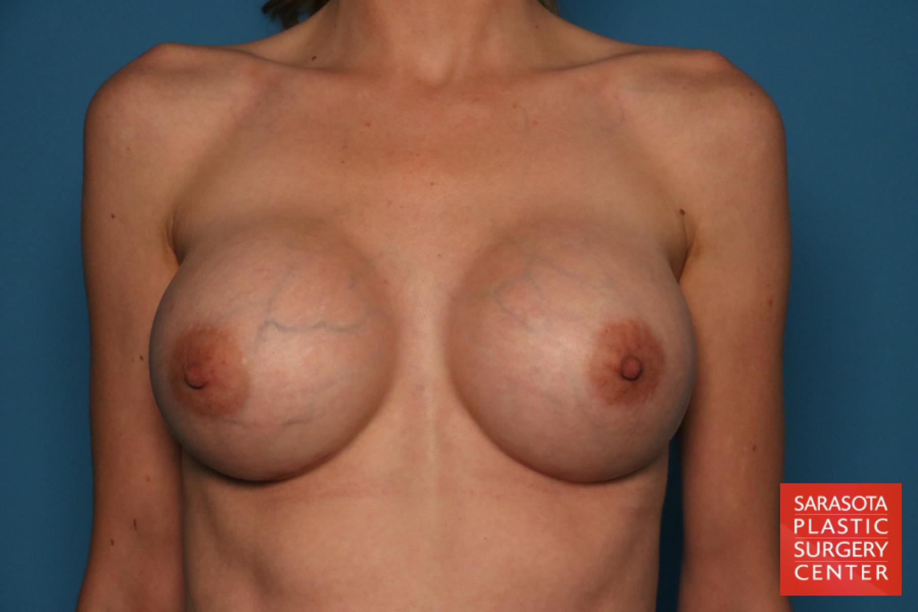 Breast Augmentation: Patient 62 - After 1