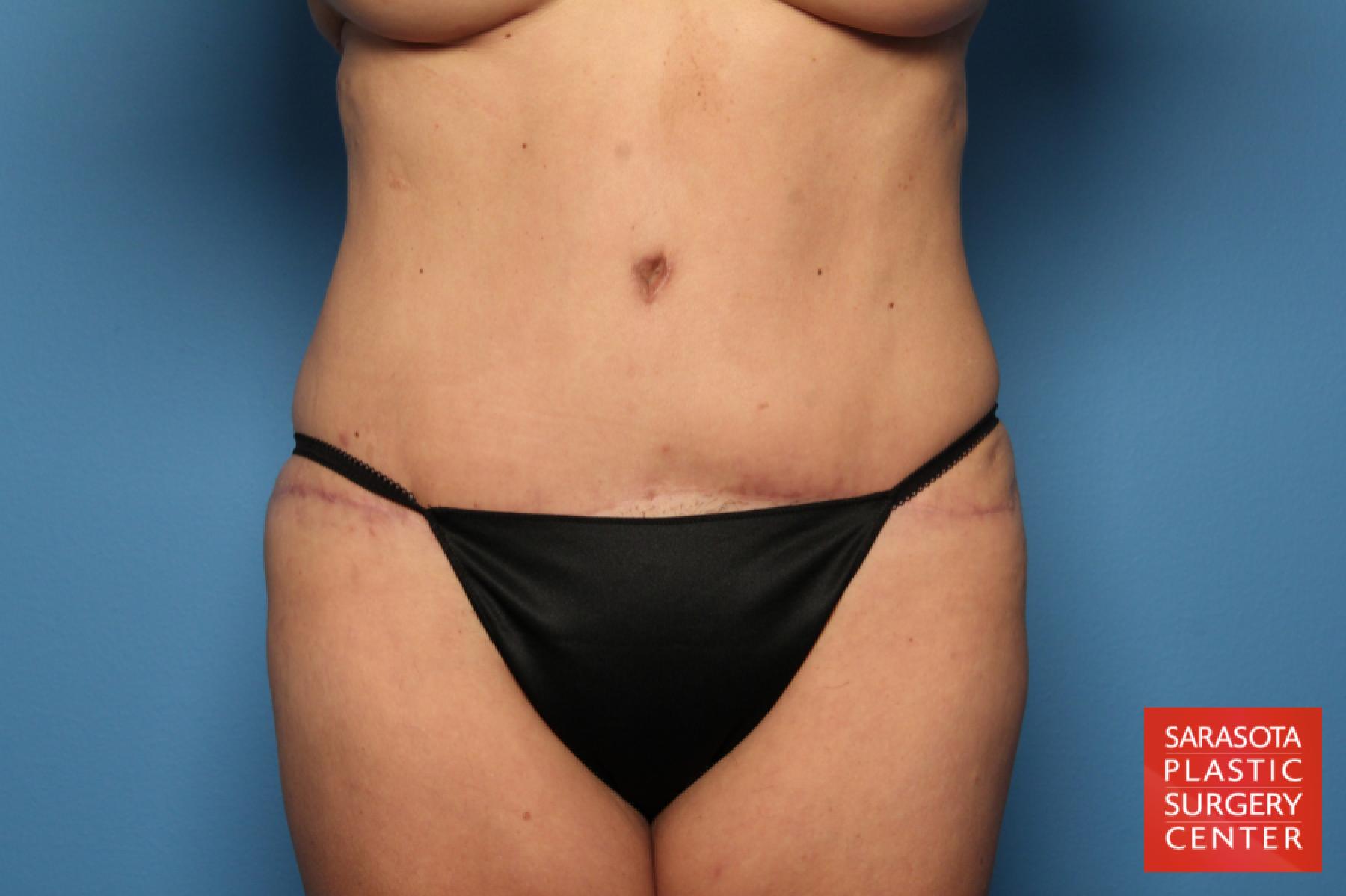 Tummy Tuck: Patient 4 - After 1