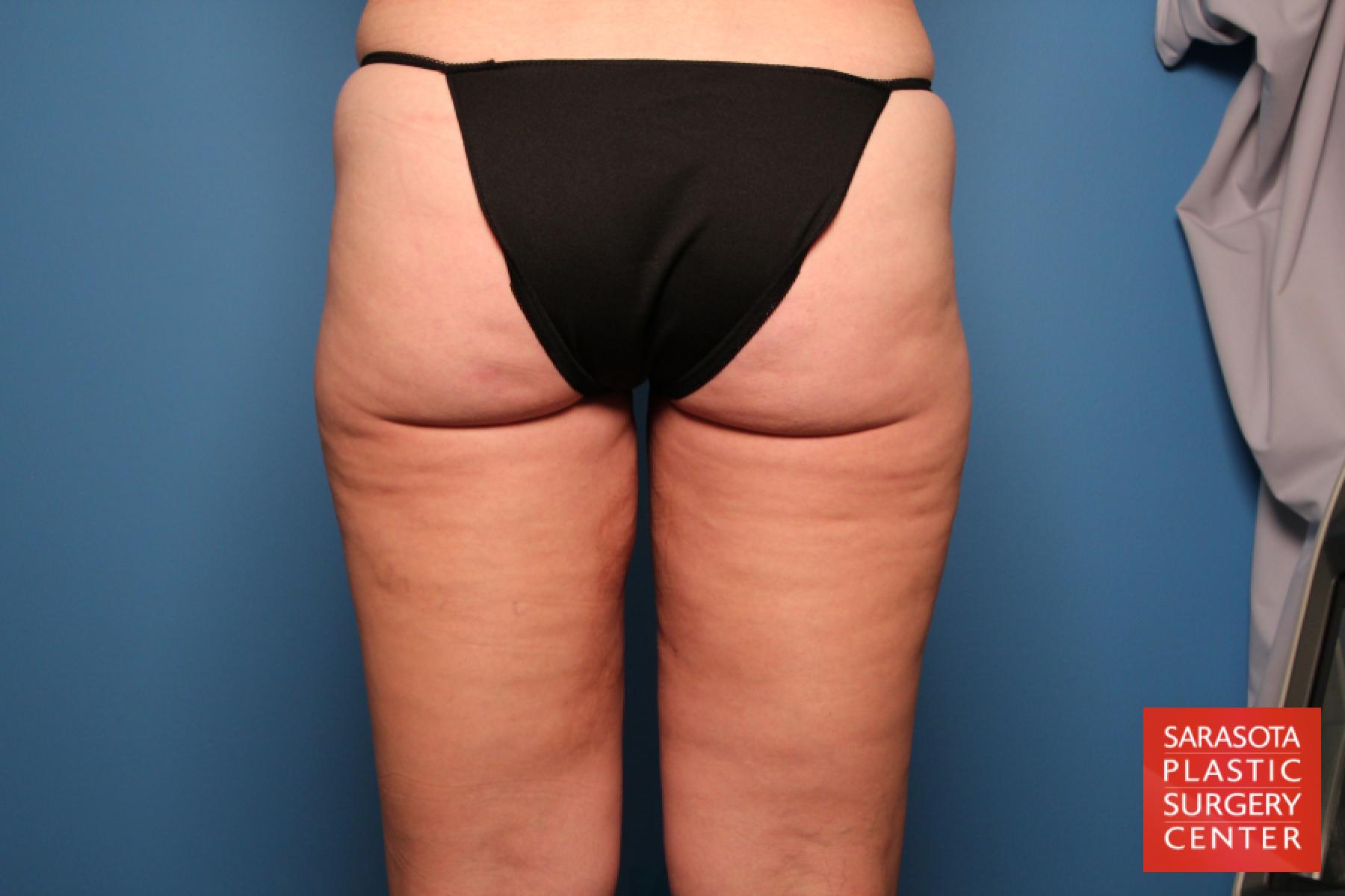 Liposuction: Patient 6 - After 4