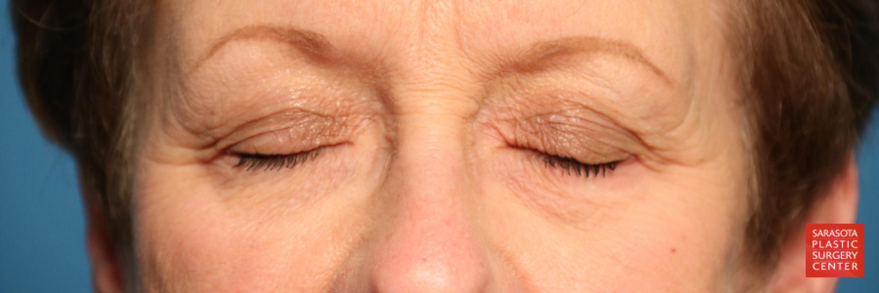 Eyelid Lift: Patient 20 - Before 3