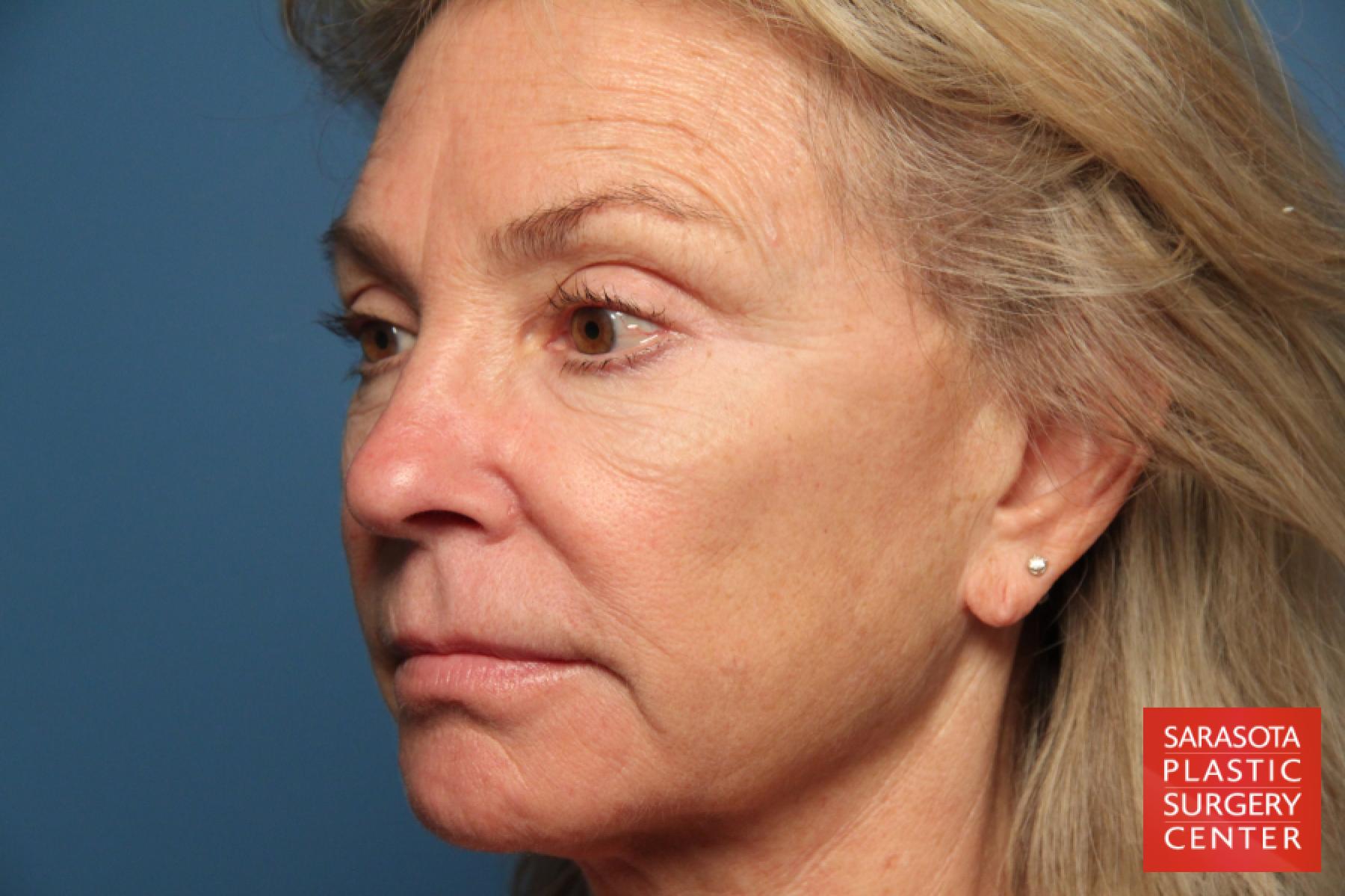 Laser Skin Resurfacing - Face: Patient 9 - Before 2