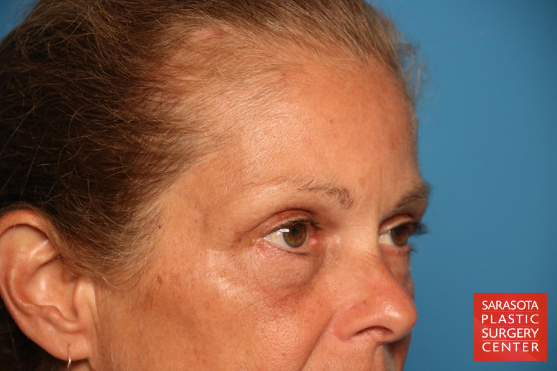 Eyelid Lift: Patient 46 - After 2