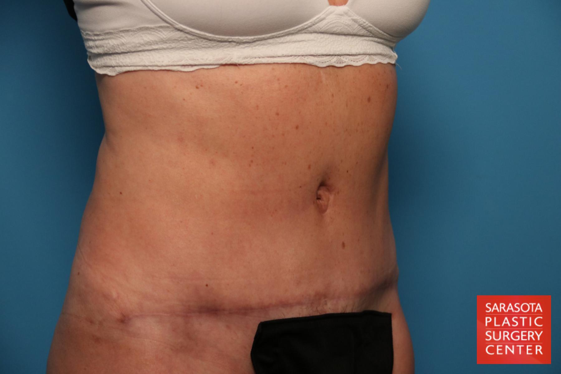 Tummy Tuck: Patient 22 - After 2
