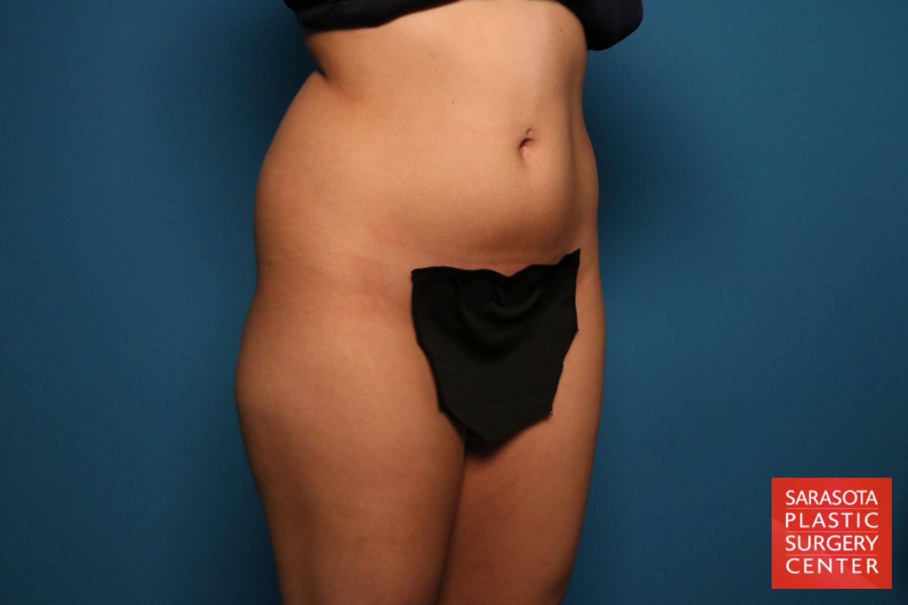 Liposuction: Patient 15 - Before 5