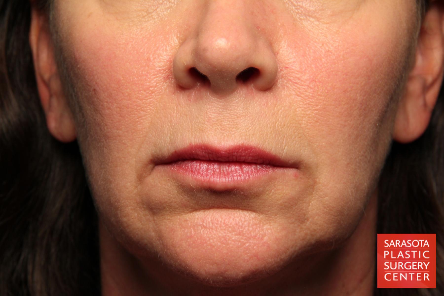 Fat Transfer   Face Revision: Patient 1 - Before 1