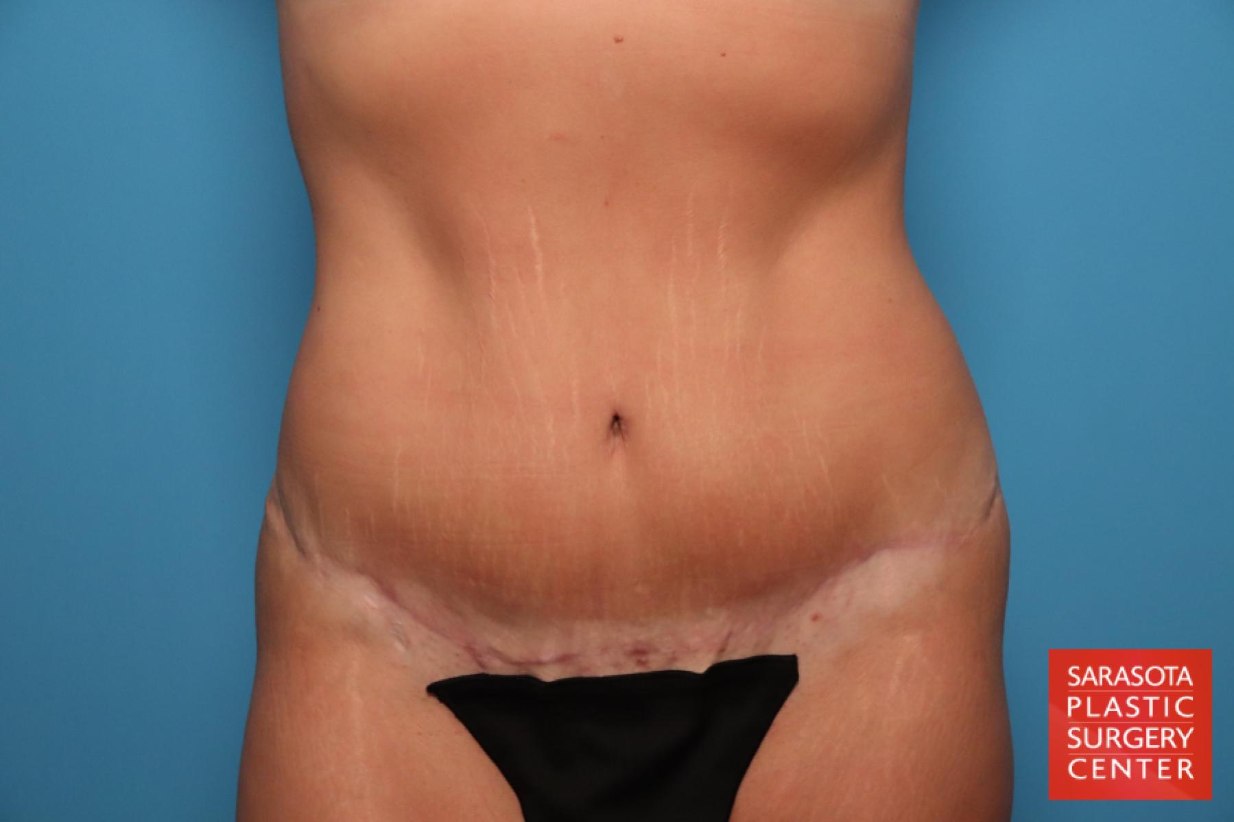 Tummy Tuck: Patient 26 - After 1