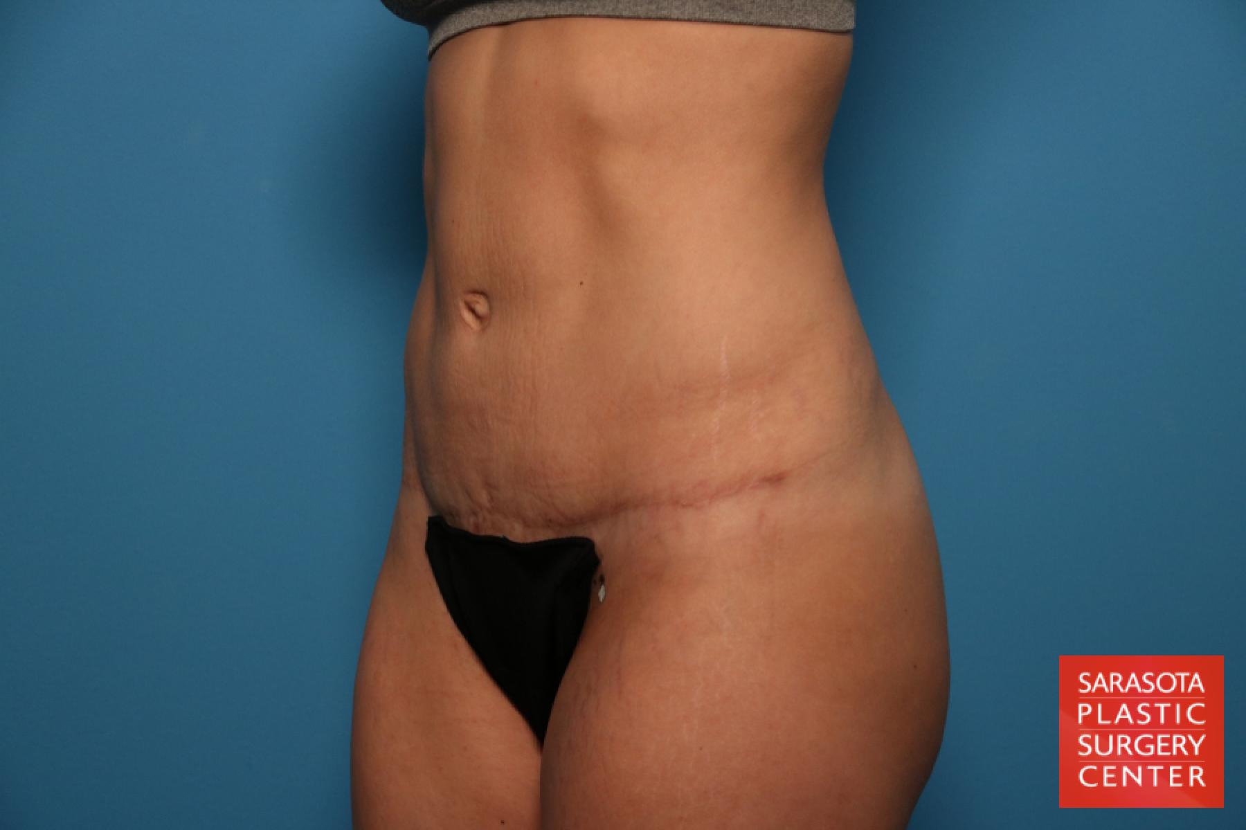 Tummy Tuck: Patient 7 - After 2