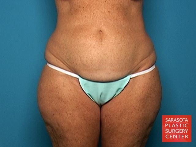 Liposuction: Patient 9 - Before 1