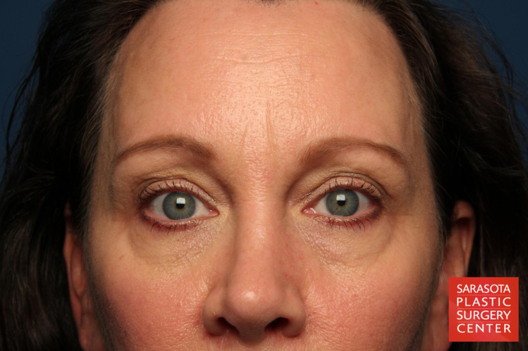Eyelid Lift: Patient 40 - Before 1