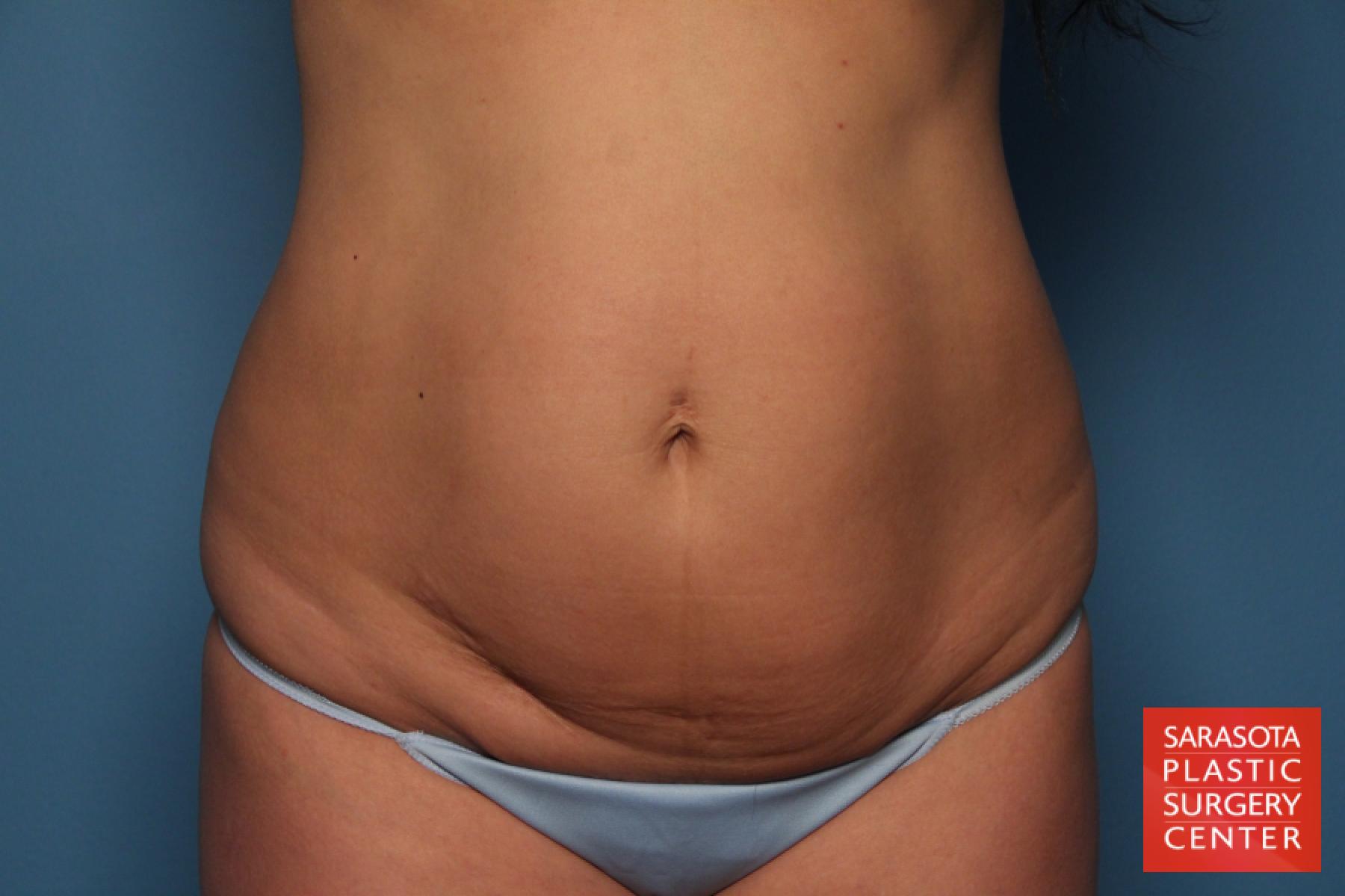 Tummy Tuck: Patient 12 - Before 1