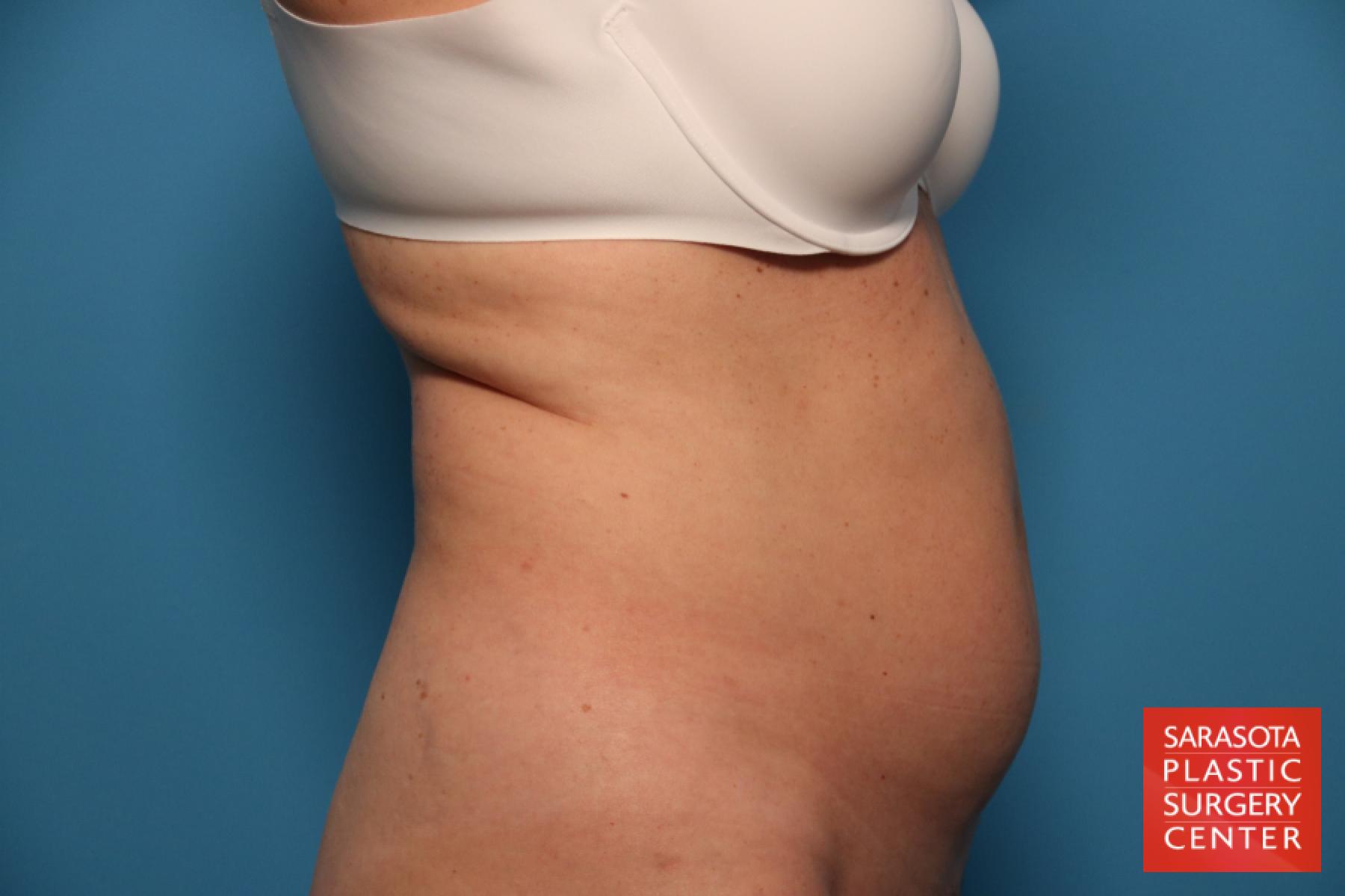 Tummy Tuck: Patient 22 - Before and After 3