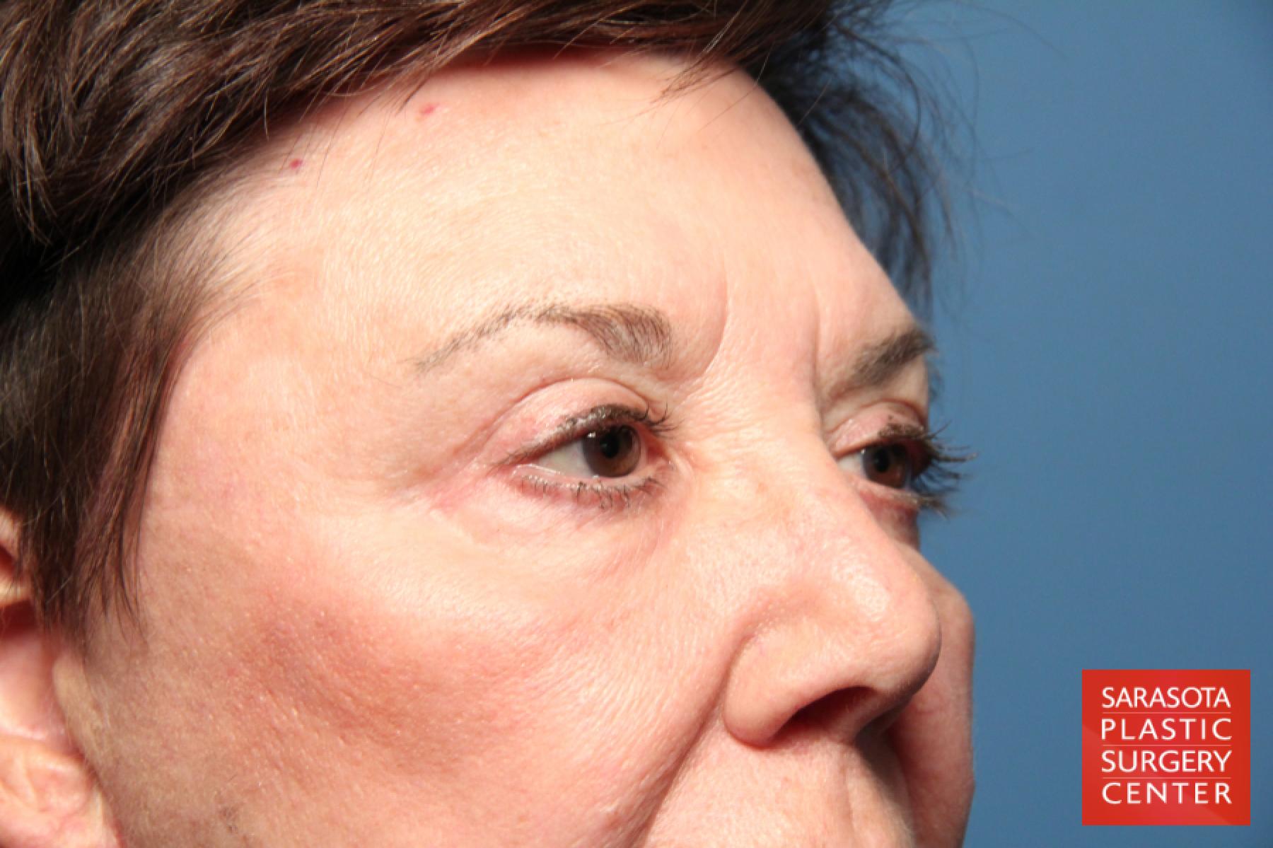 Eyelid Lift: Patient 17 - After 4