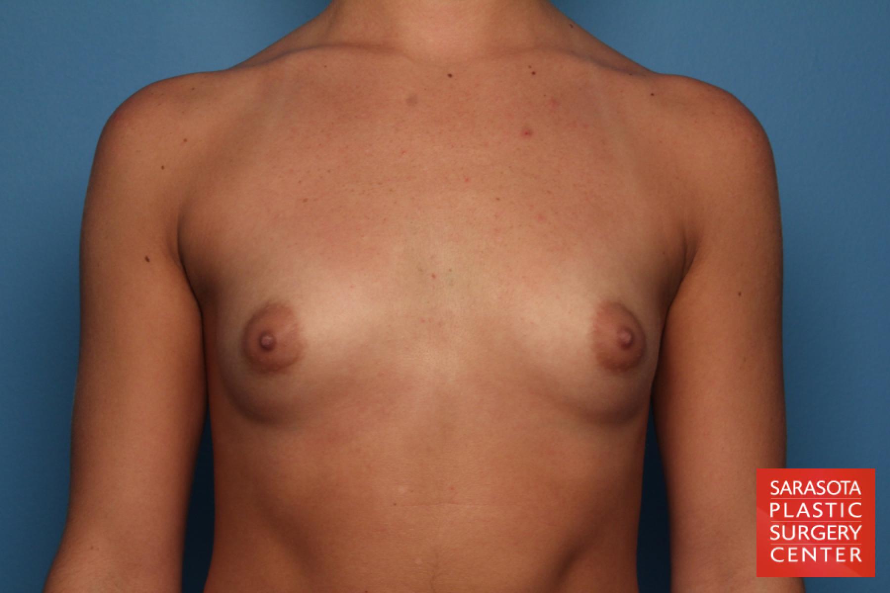 Breast Augmentation: Patient 65 - Before 1