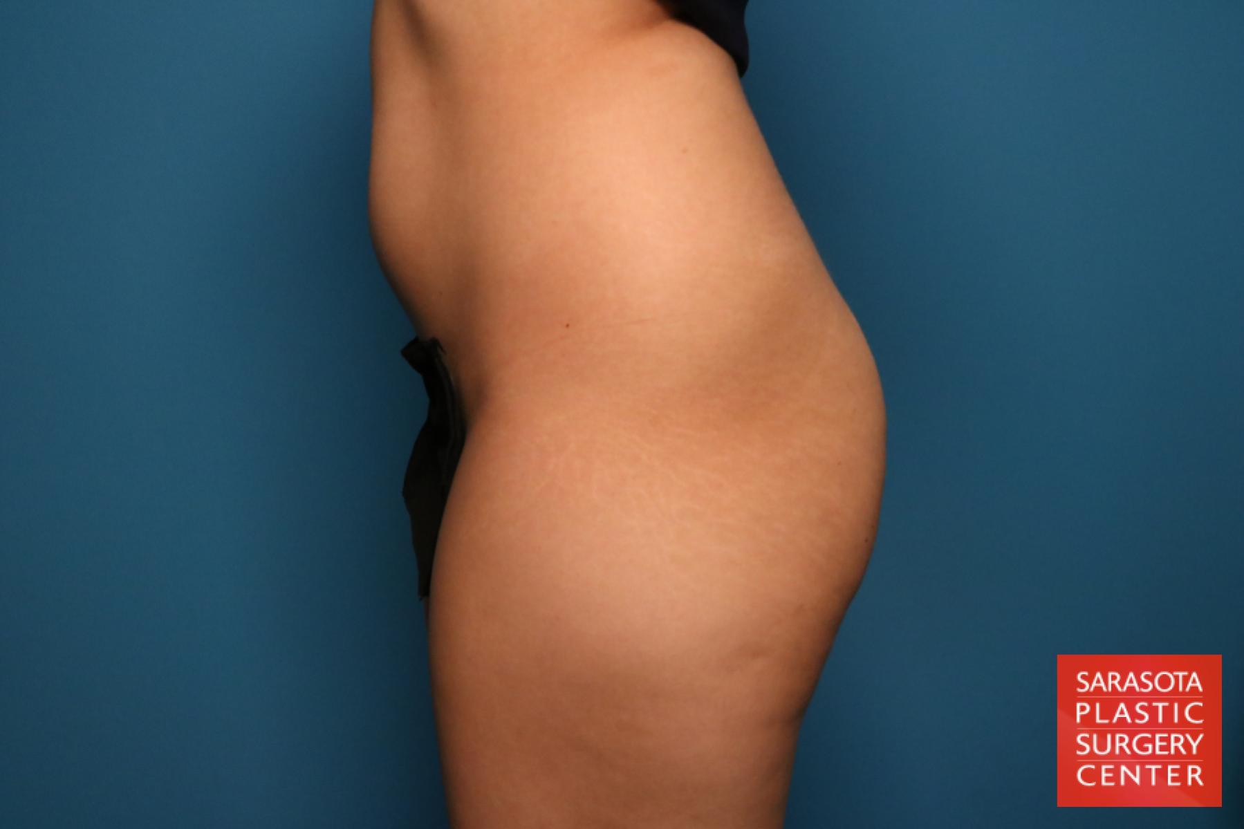 Liposuction: Patient 15 - Before 3