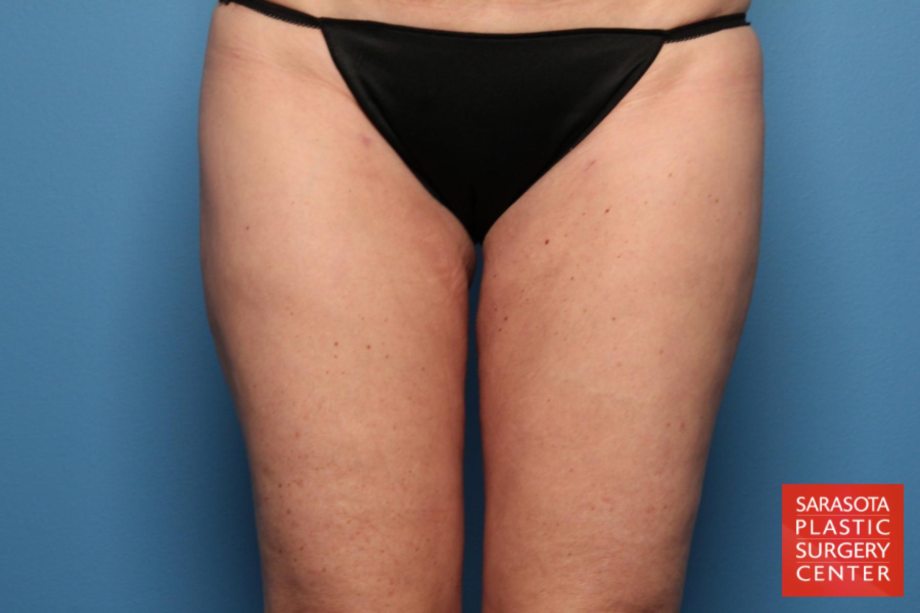 Liposuction: Patient 11 - After 1