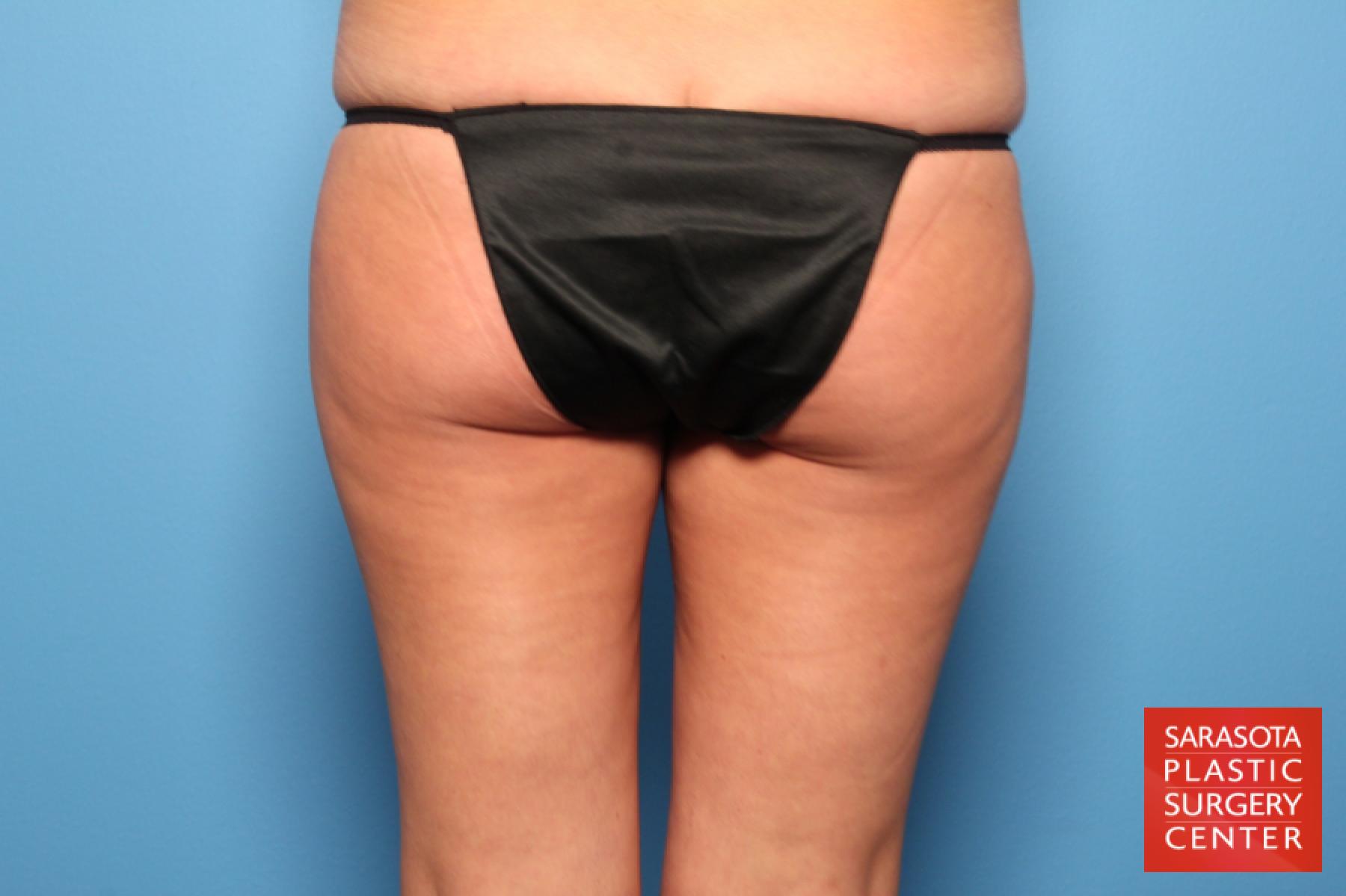 Liposuction: Patient 12 - Before 2