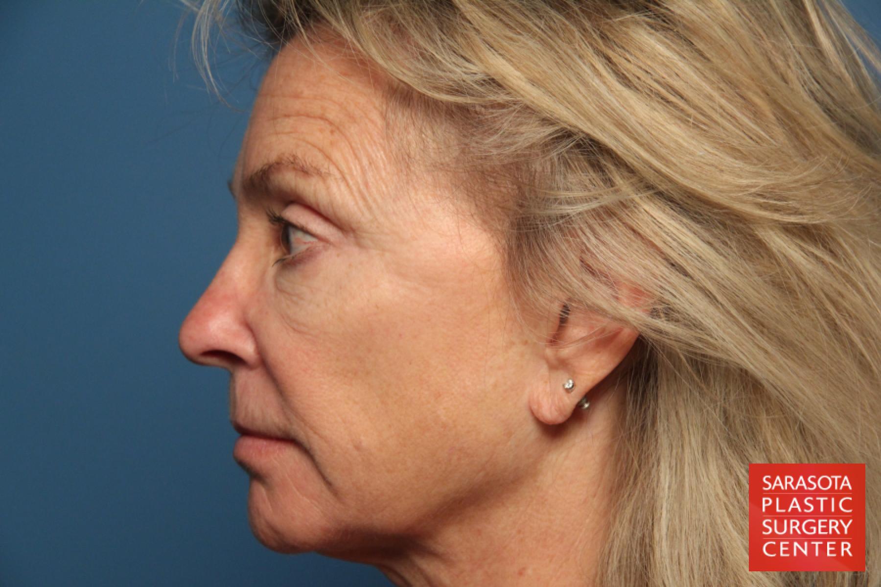 Laser Skin Resurfacing - Face: Patient 9 - Before 3