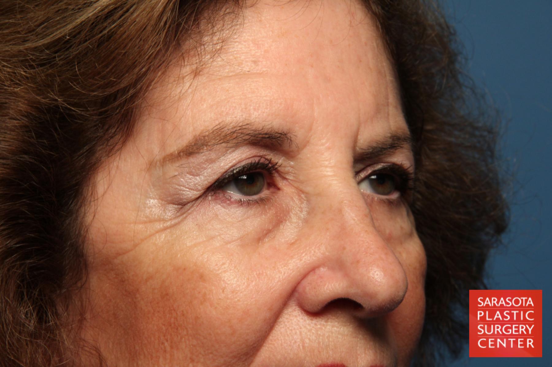 Eyelid Lift: Patient 42 - Before 6