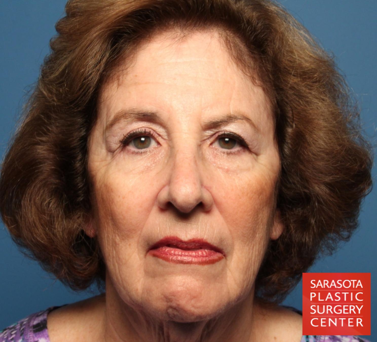Laser Skin Resurfacing - Face: Patient 6 - Before 1