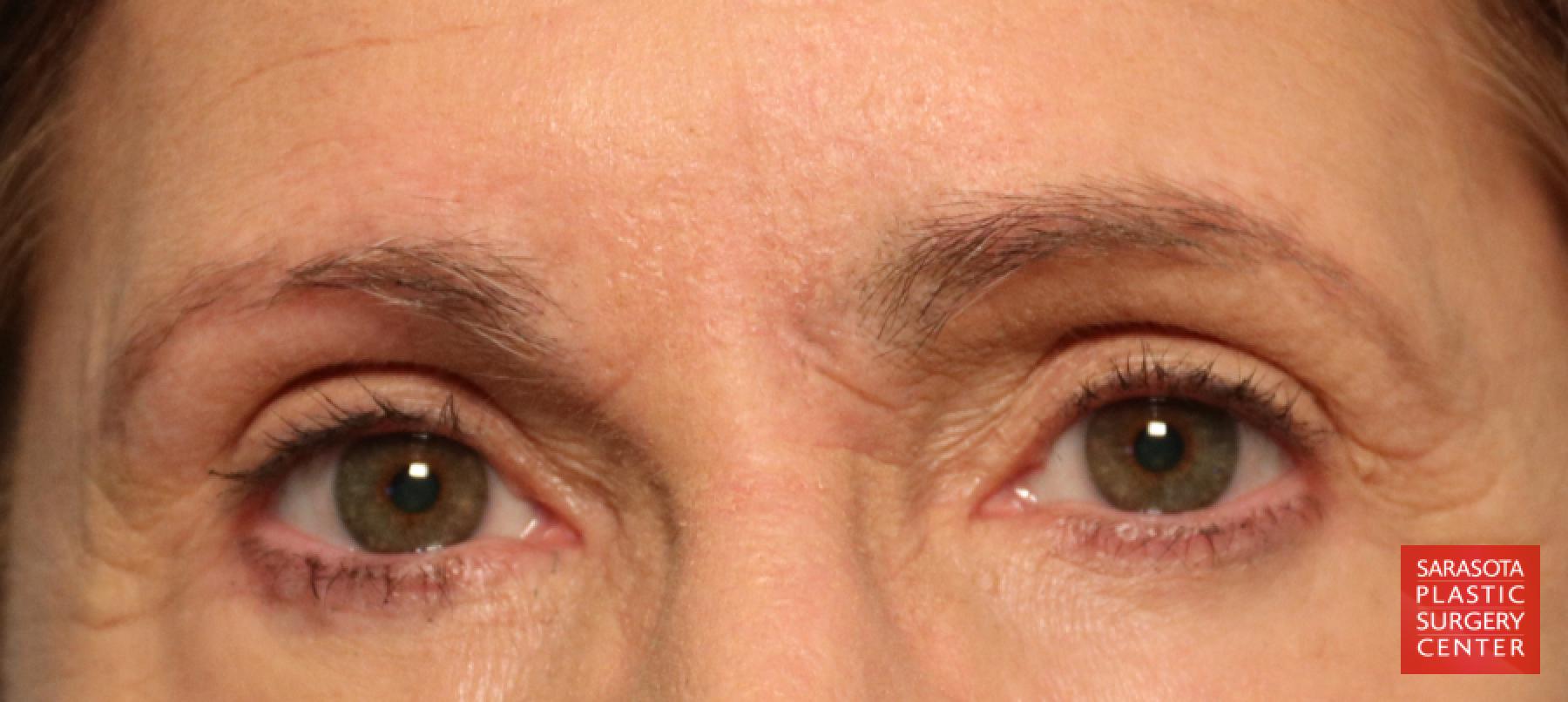 Eyelid Lift: Patient 28 - After 1