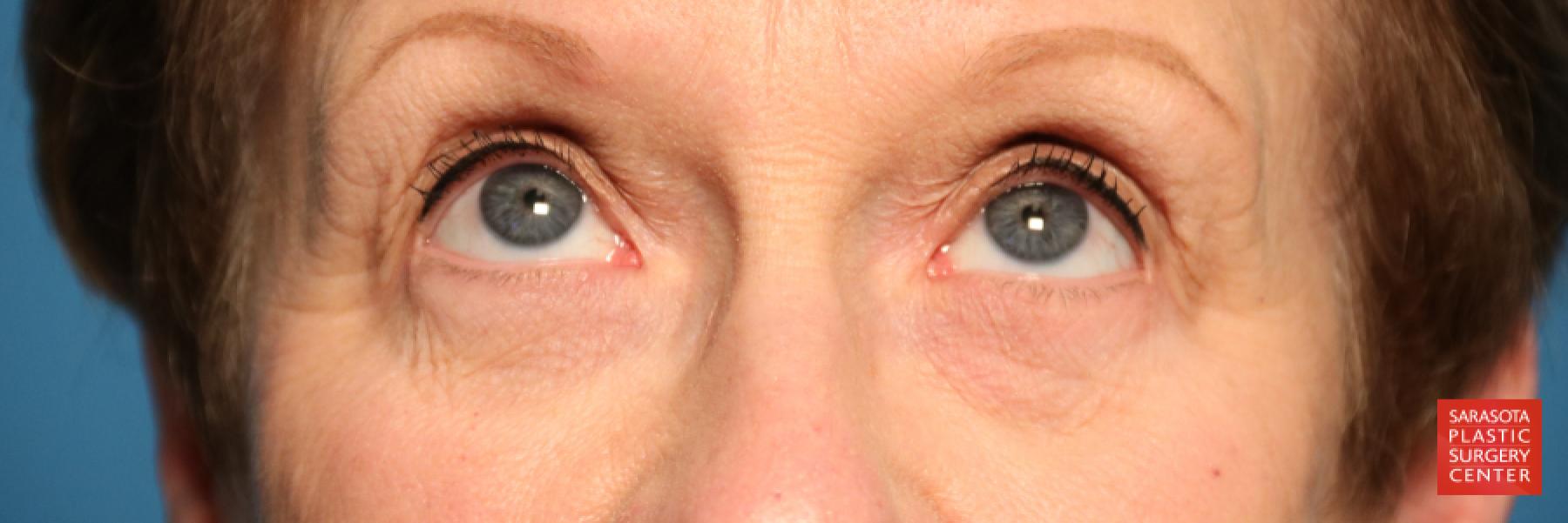 Eyelid Lift: Patient 20 - Before 2
