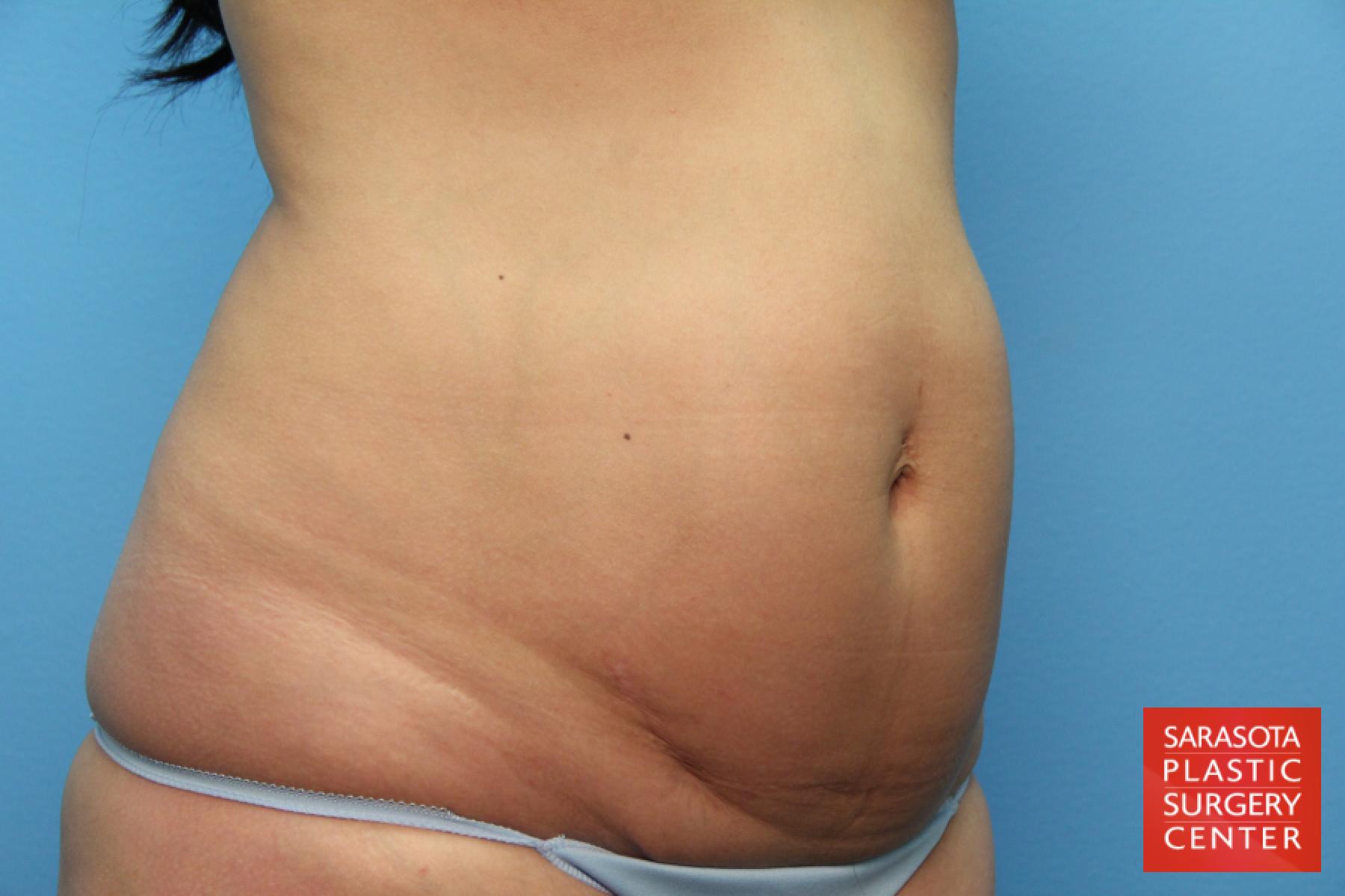 Tummy Tuck: Patient 12 - Before and After 8