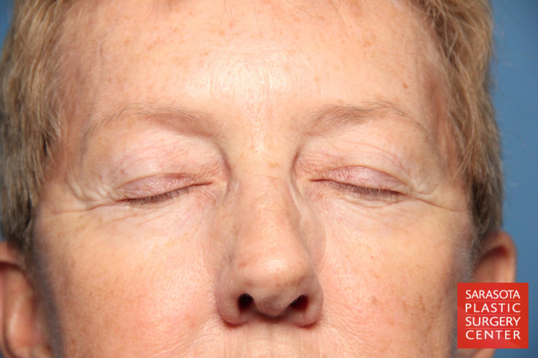 Eyelid Lift: Patient 22 - Before 2