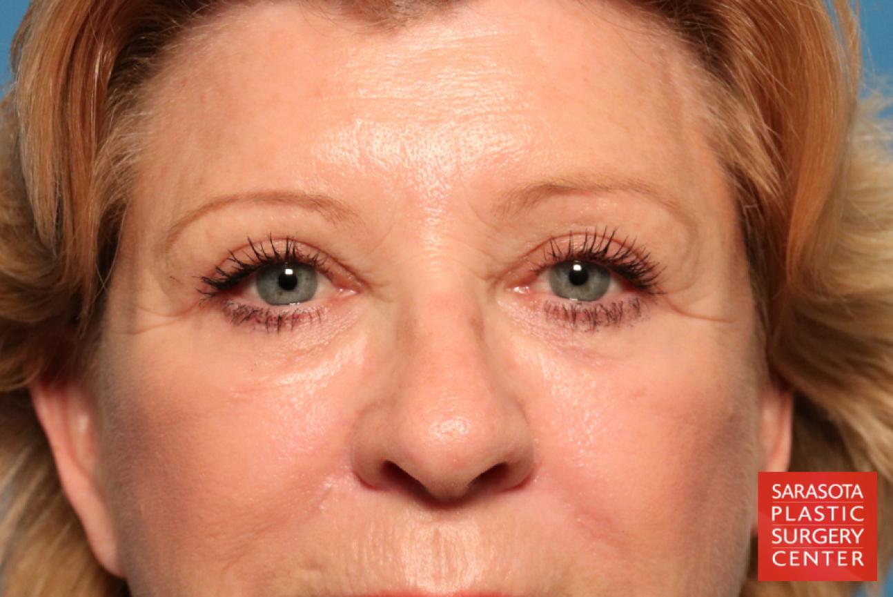 Eyelid Lift: Patient 16 - After 1