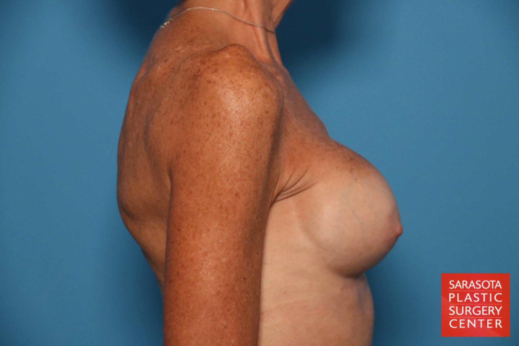 Breast Revision: Patient 7 - After 5