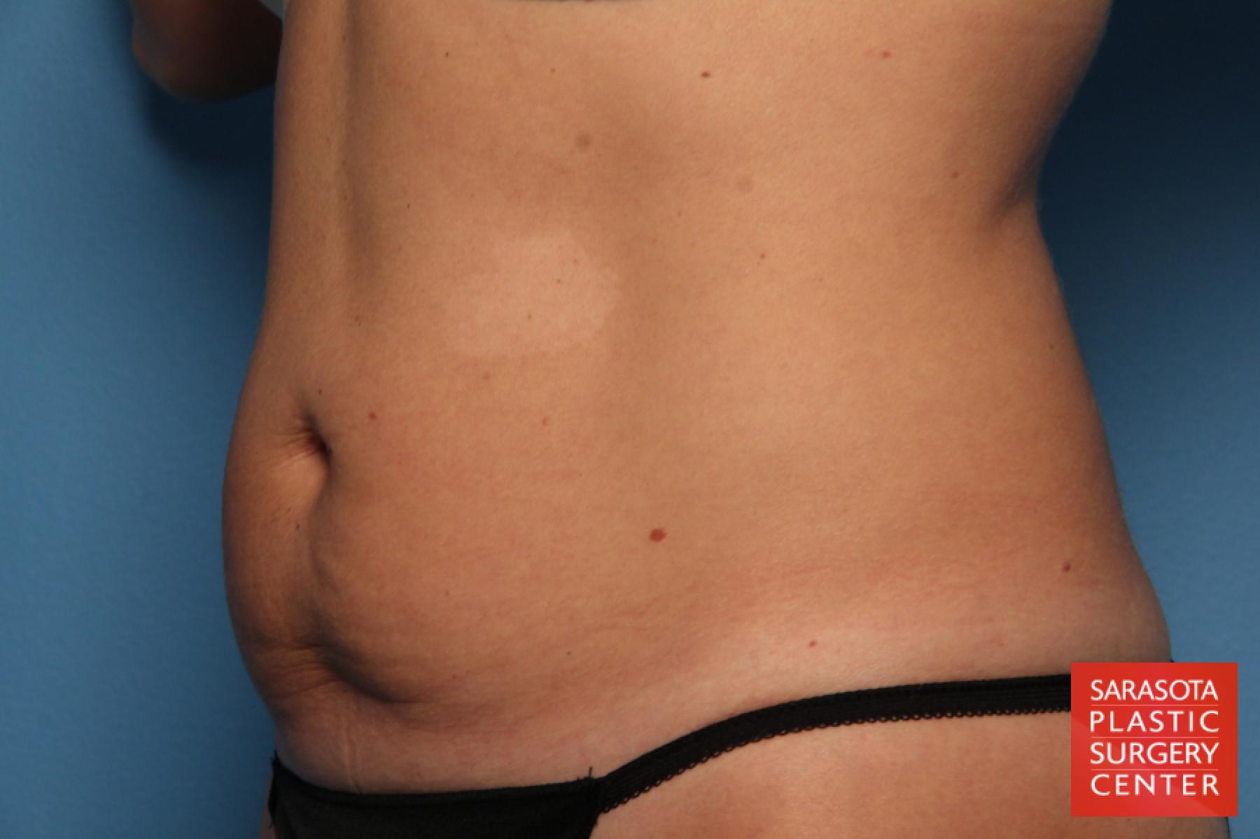 Tummy Tuck: Patient 8 - Before 2