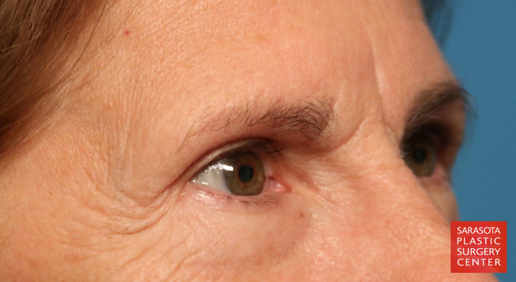 Brow Lift: Patient 1 - Before 4