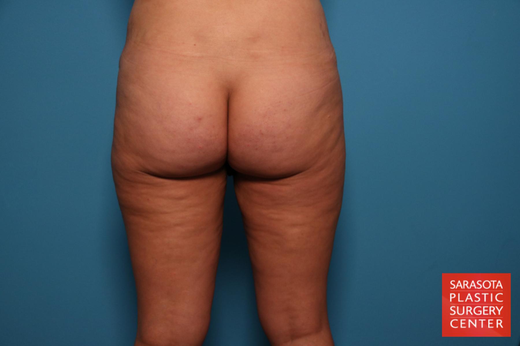 Liposuction: Patient 7 - After 5
