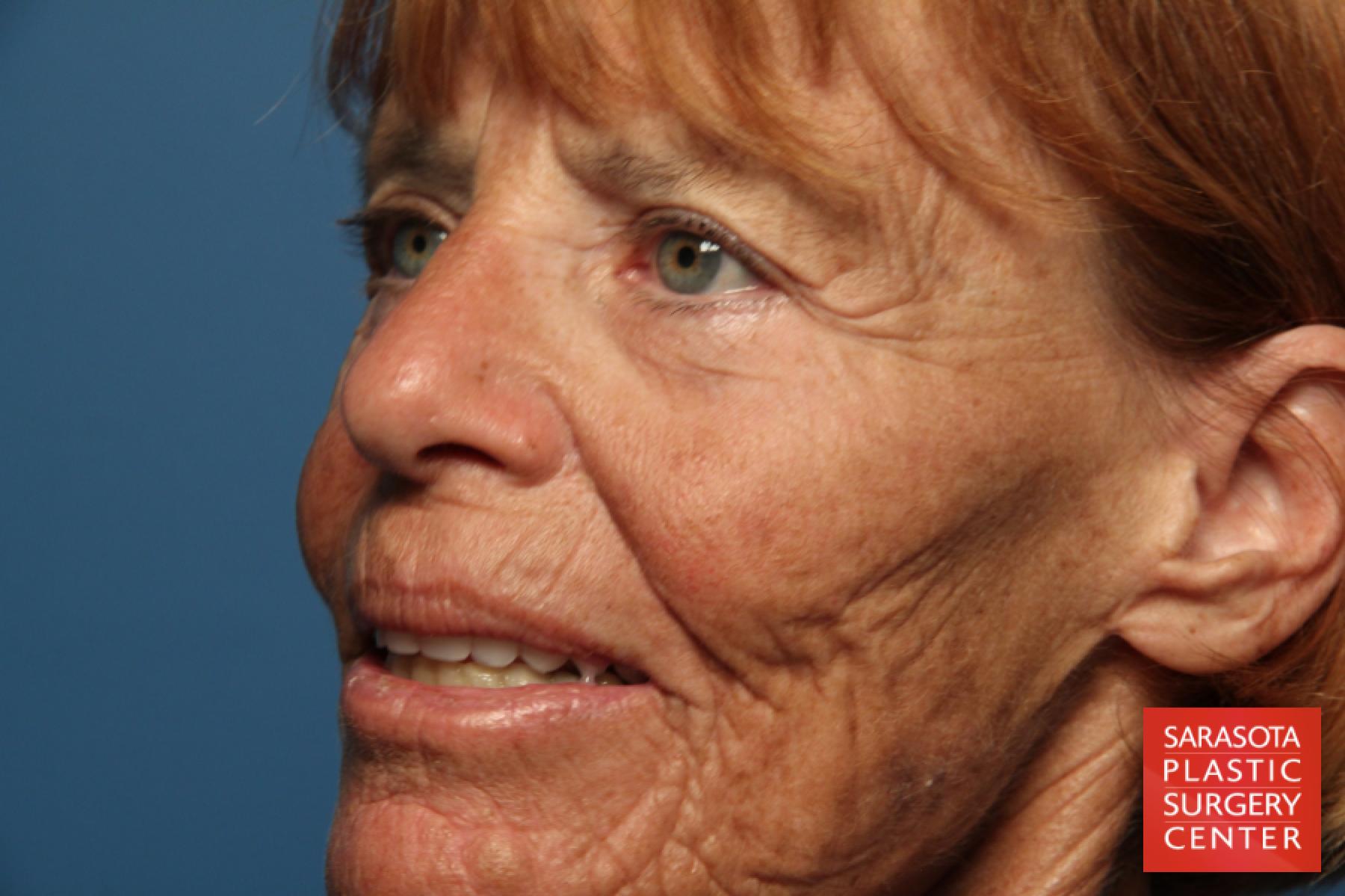 Laser Skin Resurfacing - Face: Patient 16 - Before 2