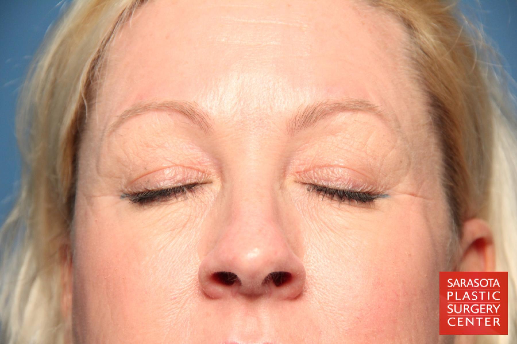 Eyelid Lift: Patient 4 - Before and After 5