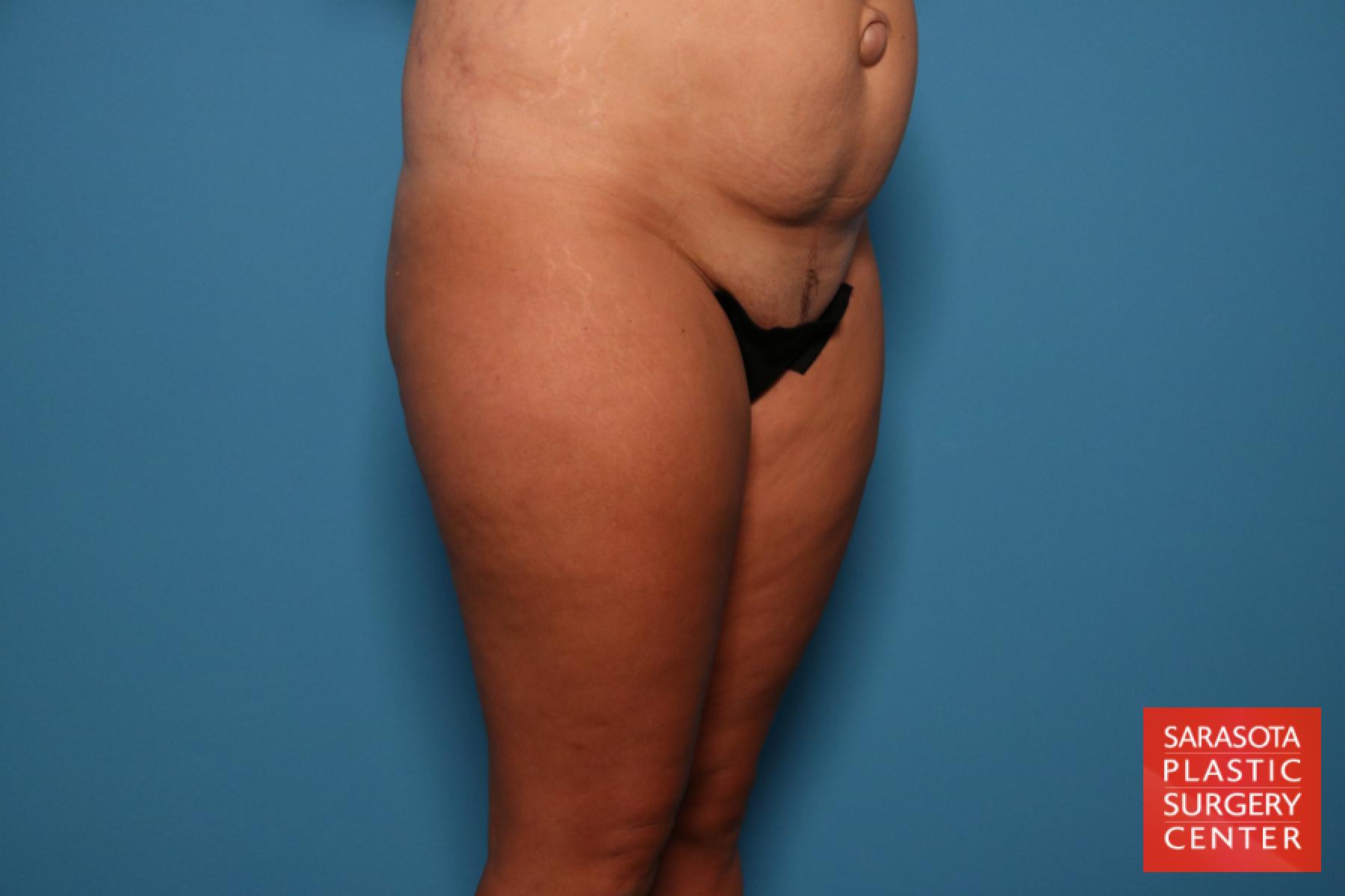 Liposuction: Patient 7 - Before and After 6