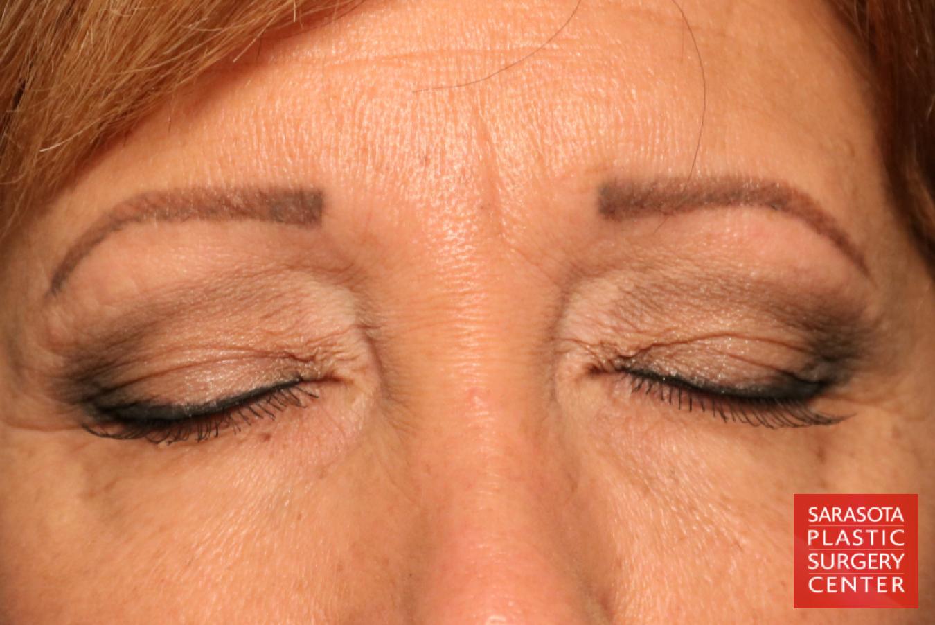 Eyelid Lift: Patient 9 - Before 2
