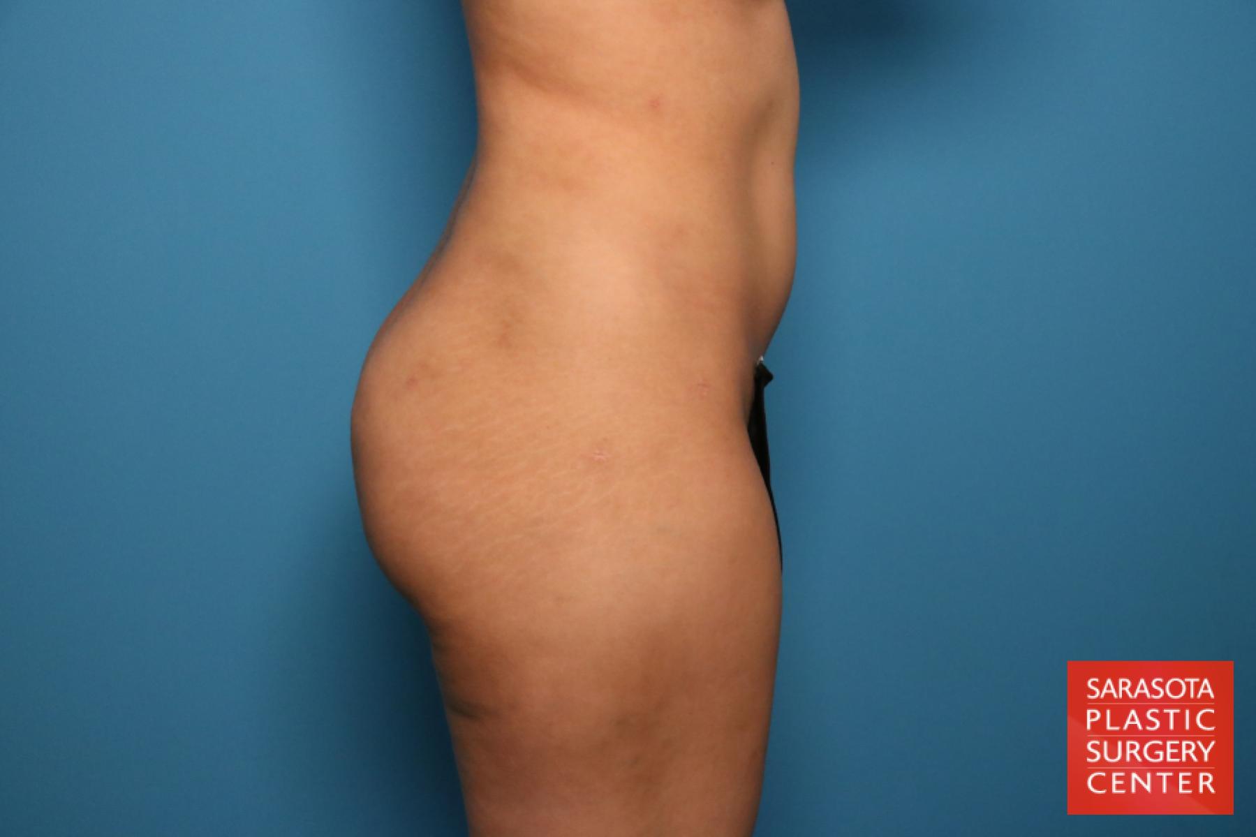 Liposuction: Patient 15 - After 6