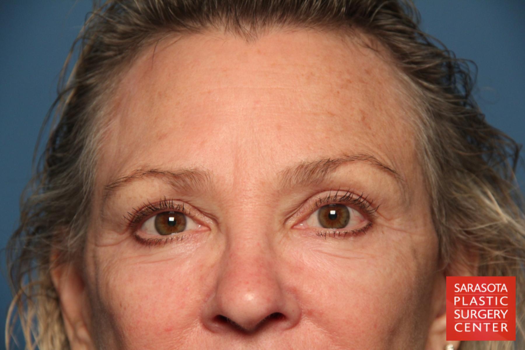Laser Skin Resurfacing - Face: Patient 9 - After 4