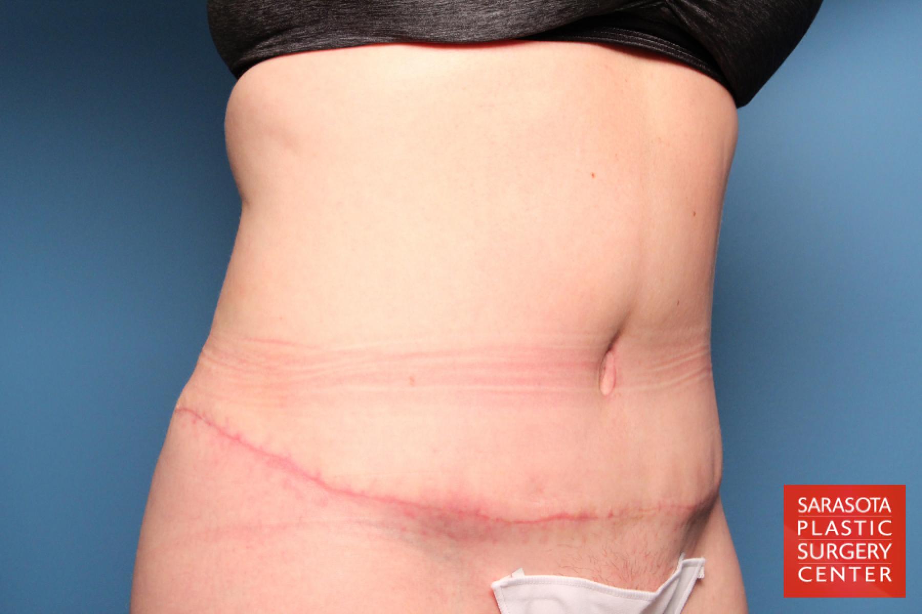 Tummy Tuck: Patient 16 - After 2