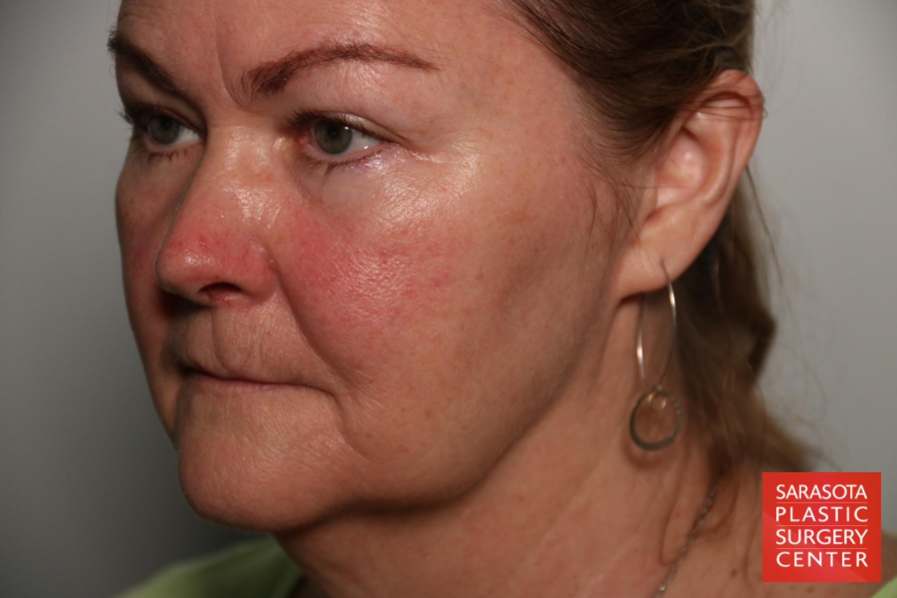 Laser Skin Resurfacing - Face: Patient 17 - Before 2