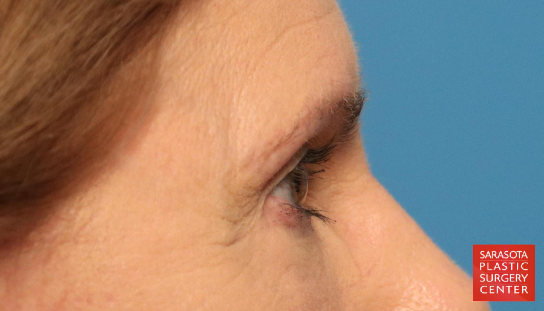 Brow Lift: Patient 1 - After 5